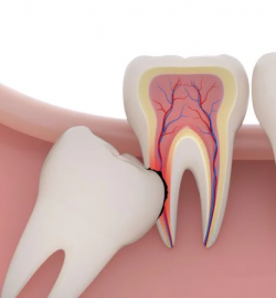 TIỂU PHẨU RĂNG KHÔNG