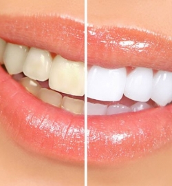 TẨY TRẮNG RĂNG KHÔNG Ê BUỐT