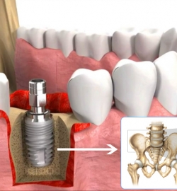 CẤY GHÉP IMPLANT
