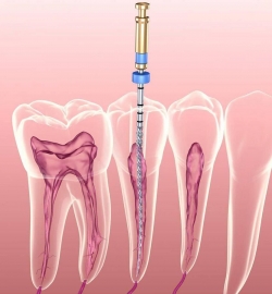 CHỮA TỦY RĂNG 3 CHÂN