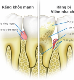 ĐIỀU TRỊ VIÊM NHA CHU