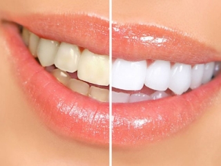 TẨY TRẮNG RĂNG KHÔNG Ê BUỐT