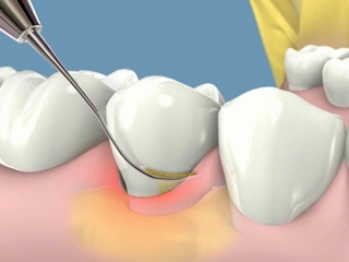 CẠO VÔI & ĐÁNH BÓNG