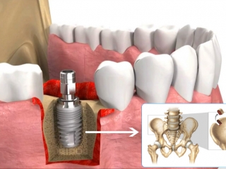 CẤY GHÉP IMPLANT