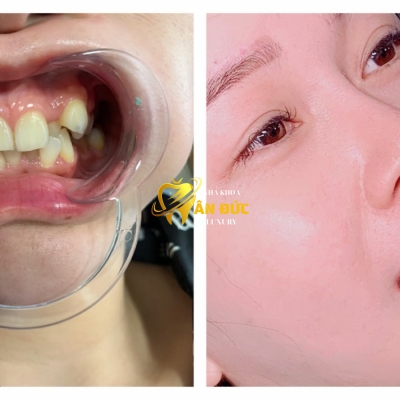 KHÁCH HÀNG TẠI NHA KHOA  ĐỨC 9