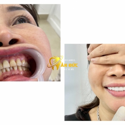 Khách hàng tai nha khoa Ân Đức Luxury